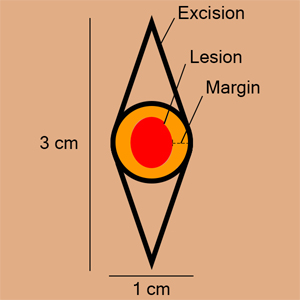 Excision Comparison Tool